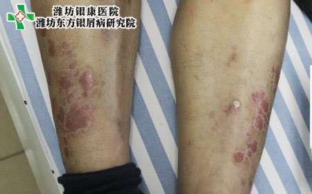 銀屑病初期癥狀,初期銀屑病癥狀