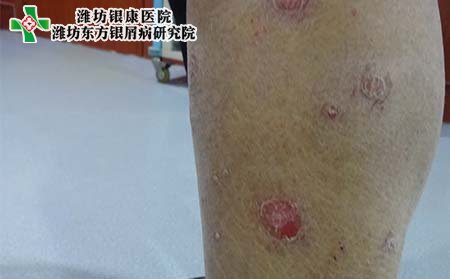 銀屑病癥狀,銀屑病癥狀特點