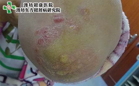 濰坊治銀屑病醫(yī)院,濰坊銀康治銀屑病