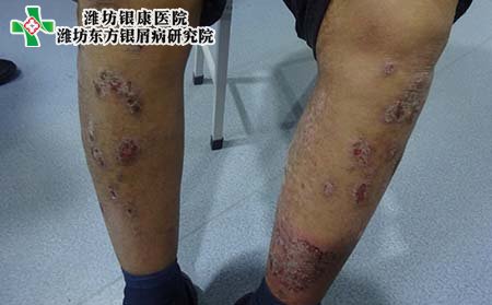 頑固銀屑病治療,怎樣治頑固銀屑病