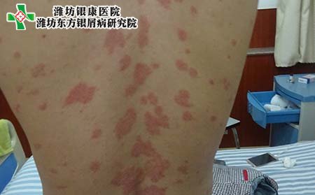 銀屑病表現(xiàn)癥狀,銀屑病有什么表現(xiàn)癥狀