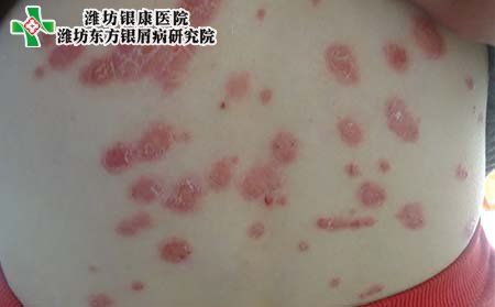 兒童銀屑病治療,點滴狀銀屑病治療