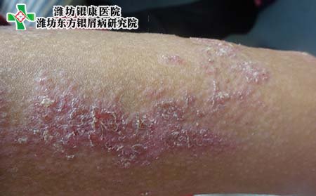 牛皮癬要怎樣治,要怎樣去治牛皮癬