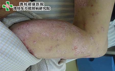 牛皮癬發(fā)病癥狀,長牛皮癬有什么癥狀