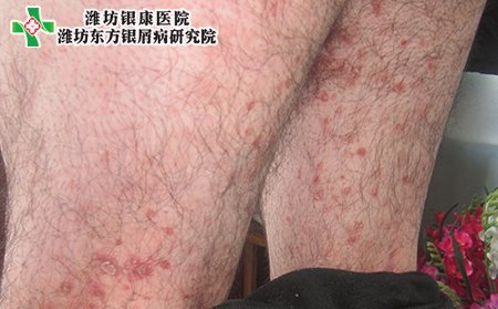 濰坊銀康醫院:治療銀屑癬的快速的藥物