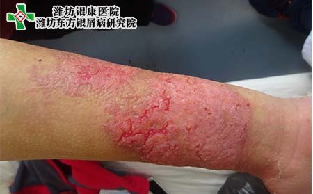 兒童牛皮癬癥狀,兒童牛皮癬癥狀表現(xiàn)