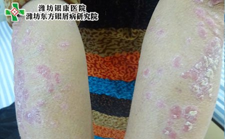 兒童銀屑病治療,怎樣治兒童銀屑病