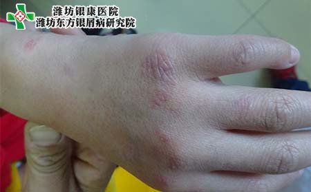 銀屑病遺傳,銀屑病遺傳孩子嗎