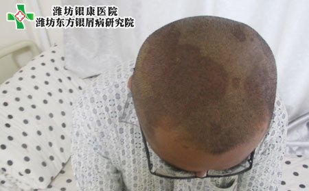 頭部牛皮癬癥狀,頭部的牛皮癬表現(xiàn)