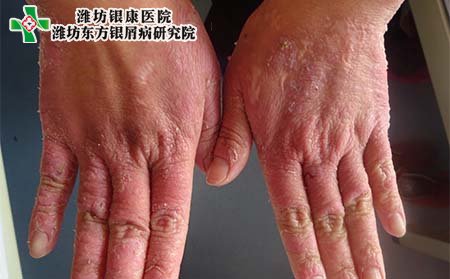 手部牛皮癬癥狀,手上牛皮癬癥狀表現