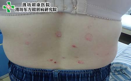 銀屑病癥狀,銀屑病發作期癥狀