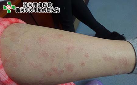 銀屑病怎樣治,皮膚銀屑病怎樣治療