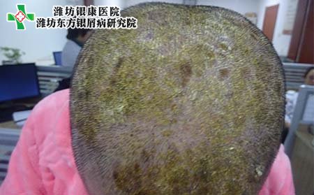 頭部銀屑病癥狀,頭部銀屑病好轉(zhuǎn)表現(xiàn)