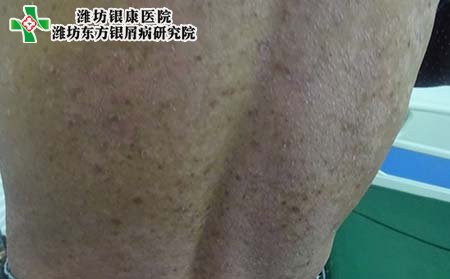 銀屑病癥狀表現,怎樣判斷銀屑病癥狀