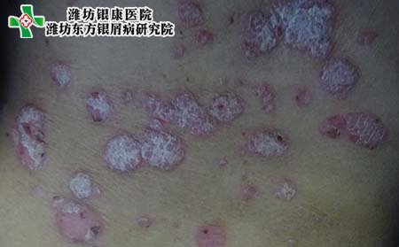 尋常型牛皮癬癥狀,尋常型牛皮癬有什么表現