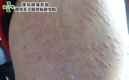 銀屑病癥狀,銀屑病典型癥狀
