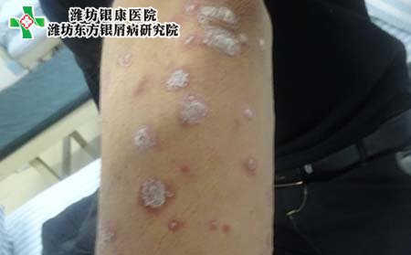 銀屑病癥狀,銀屑病臨床癥狀表現