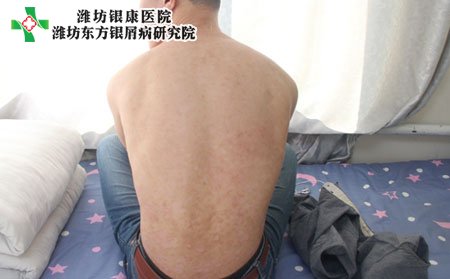 尋常型銀屑病,尋常型銀屑病護理