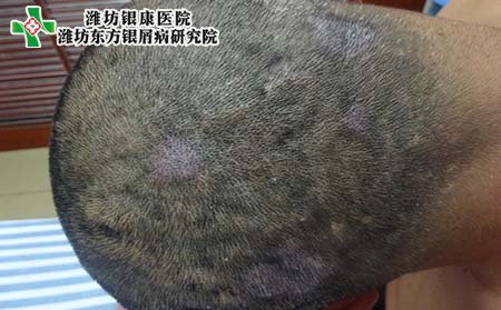 頭部銀屑病危害,頭部長銀屑病的危害