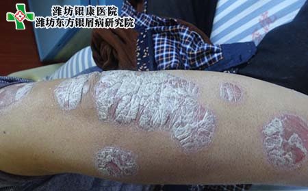 銀屑病治療,銀屑病好不好治
