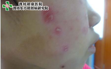 銀屑病治療,面部銀屑病治療