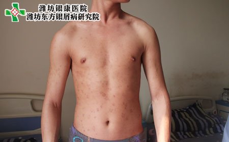 牛皮癬如何預防,男性牛皮癬怎樣預防