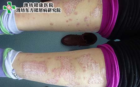 牛皮癬癥狀,怎樣診斷牛皮癬癥狀