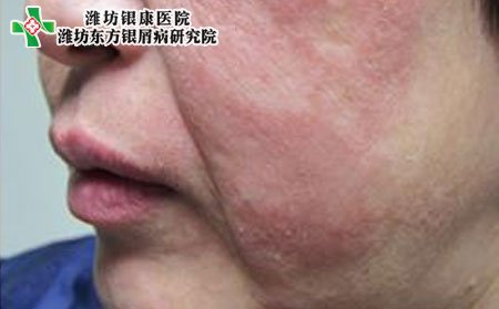 銀屑病治療,頭部銀屑病治療,面部銀屑病治療