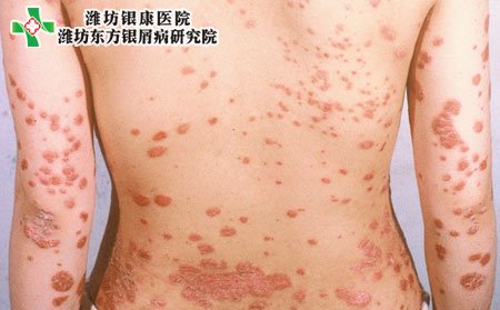 牛皮癬癥狀,尋常型牛皮癬癥狀