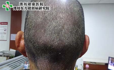 牛皮癬病因,頭部牛皮癬病因