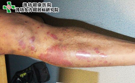 牛皮癬治療,男性牛皮癬怎樣治