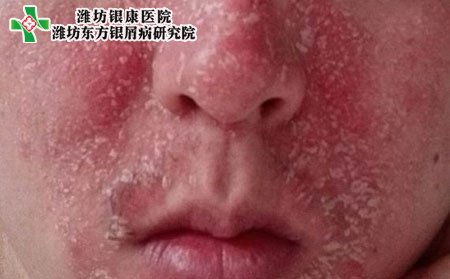 臉部牛皮癬癥狀,臉上牛皮癬什么表現(xiàn)