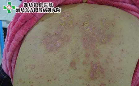 銀屑病癥狀,早期銀屑病的癥狀