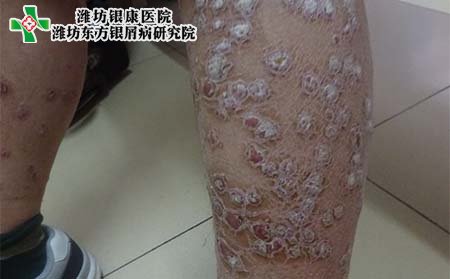 銀屑病病因,常見銀屑病病因