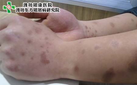 銀屑病防治,怎樣防治銀屑病