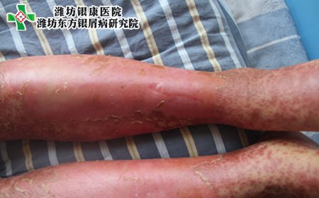 濰坊銀屑病醫(yī)院治療膿皰型銀屑病