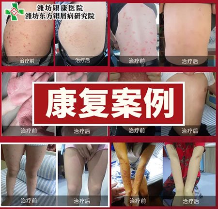 銀屑病皮膚病專家會診康復(fù)案例