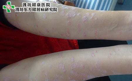 銀屑病關(guān)節(jié)炎是什么?發(fā)病原因是什么?