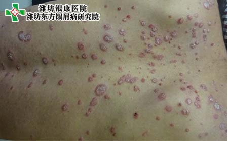 濰坊銀屑病醫院：銀屑病癥狀、類型