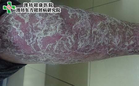 濰坊銀屑病醫院:點滴狀銀屑病治療方法、癥狀、飲食