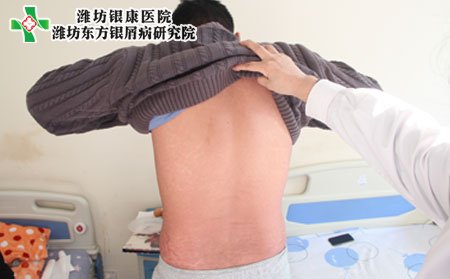 濰坊牛皮癬醫院為您介紹牛皮癬危害及圖片