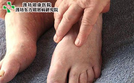 濰坊銀屑病醫院教您如何通過腳部觀測銀屑病